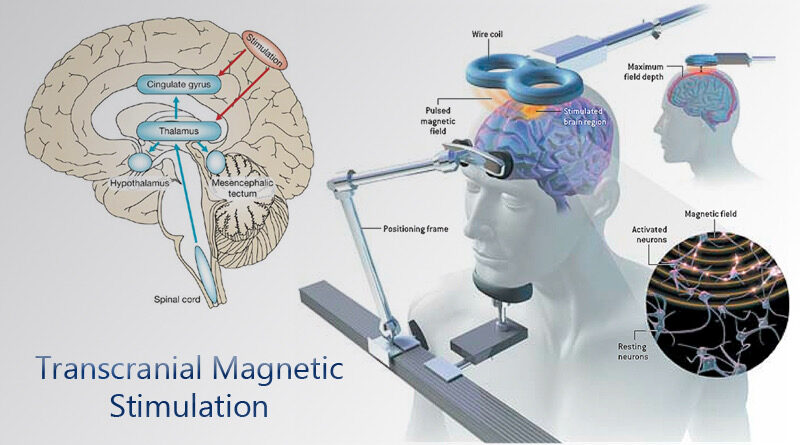 stimolazione magnetica transcranica
